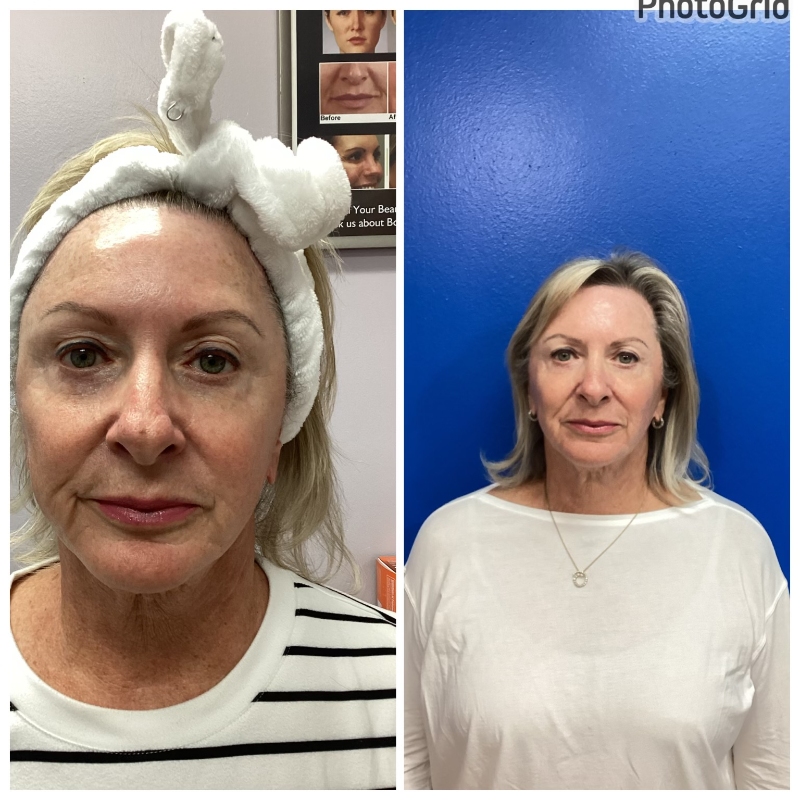 60-70 years old 4 weeks after HALO Laser Resufacing treatment of face