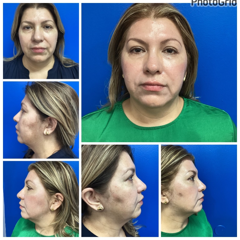45-55 year old 2 months after HALO laser resurfacing of the face