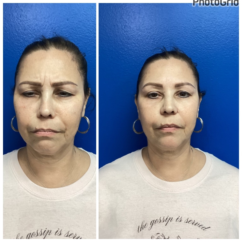 Liquid Facelift 55-65 year old lady