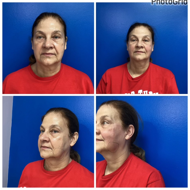 60-65 years old immediately after PDO thread-lift of the face for jowls