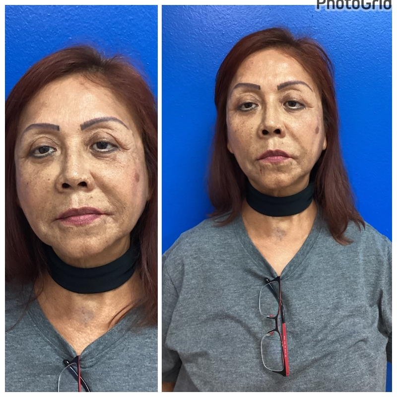 60-70 years old after liquid face lift