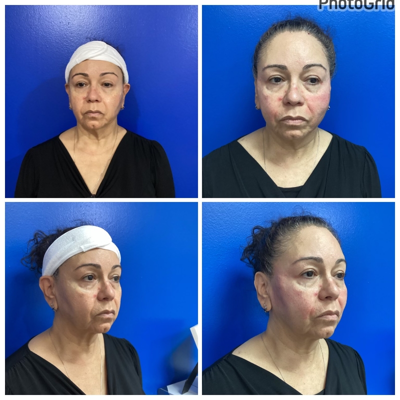 50-60 years old immediately after PDO Thread Lift face