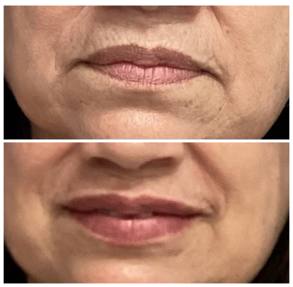 Lip Filler for Lip Lines and Thinning Lips