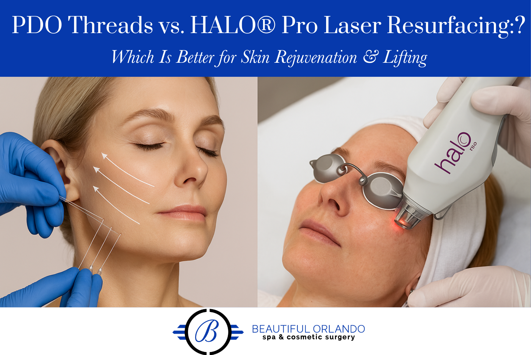 PDO Threads vs. HALO® Pro Laser Resurfacing Which Is Better for Skin Rejuvenation & Lifting