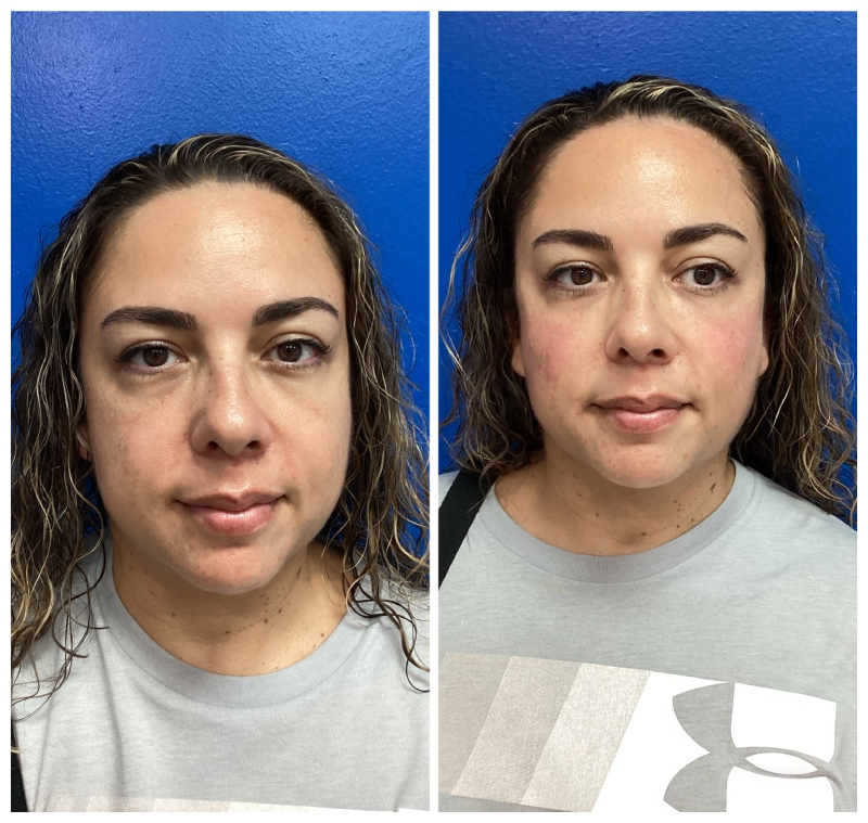 PRP Therapy with Filler